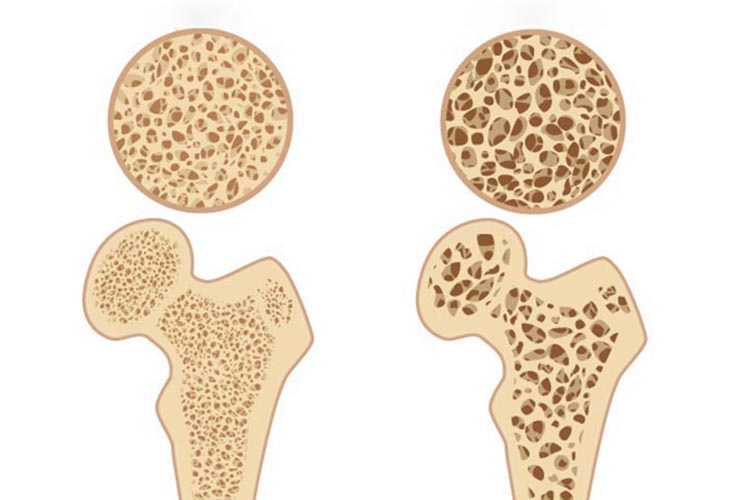 骨粗鬆症イメージ